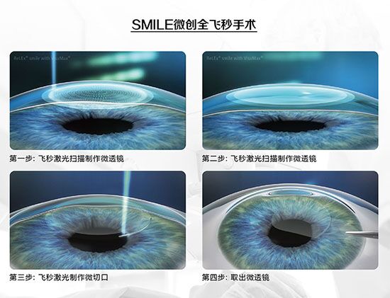 蔡司全飛秒、蔡司半飛秒近視手術(shù)與宇航飛秒的區(qū)別