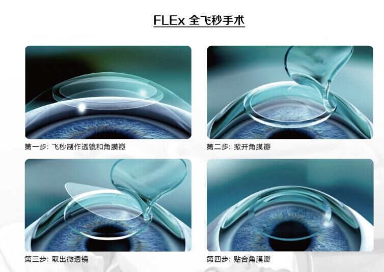 蔡司全飛秒、蔡司半飛秒近視手術(shù)與宇航飛秒的區(qū)別