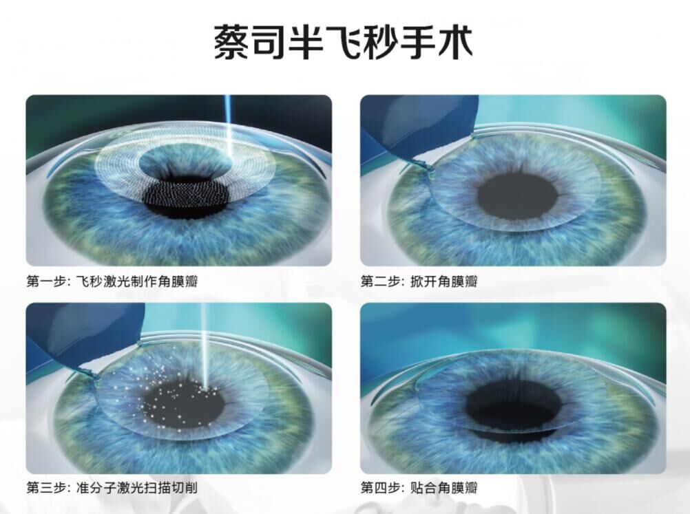 蔡司全飛秒、蔡司半飛秒近視手術(shù)與宇航飛秒的區(qū)別